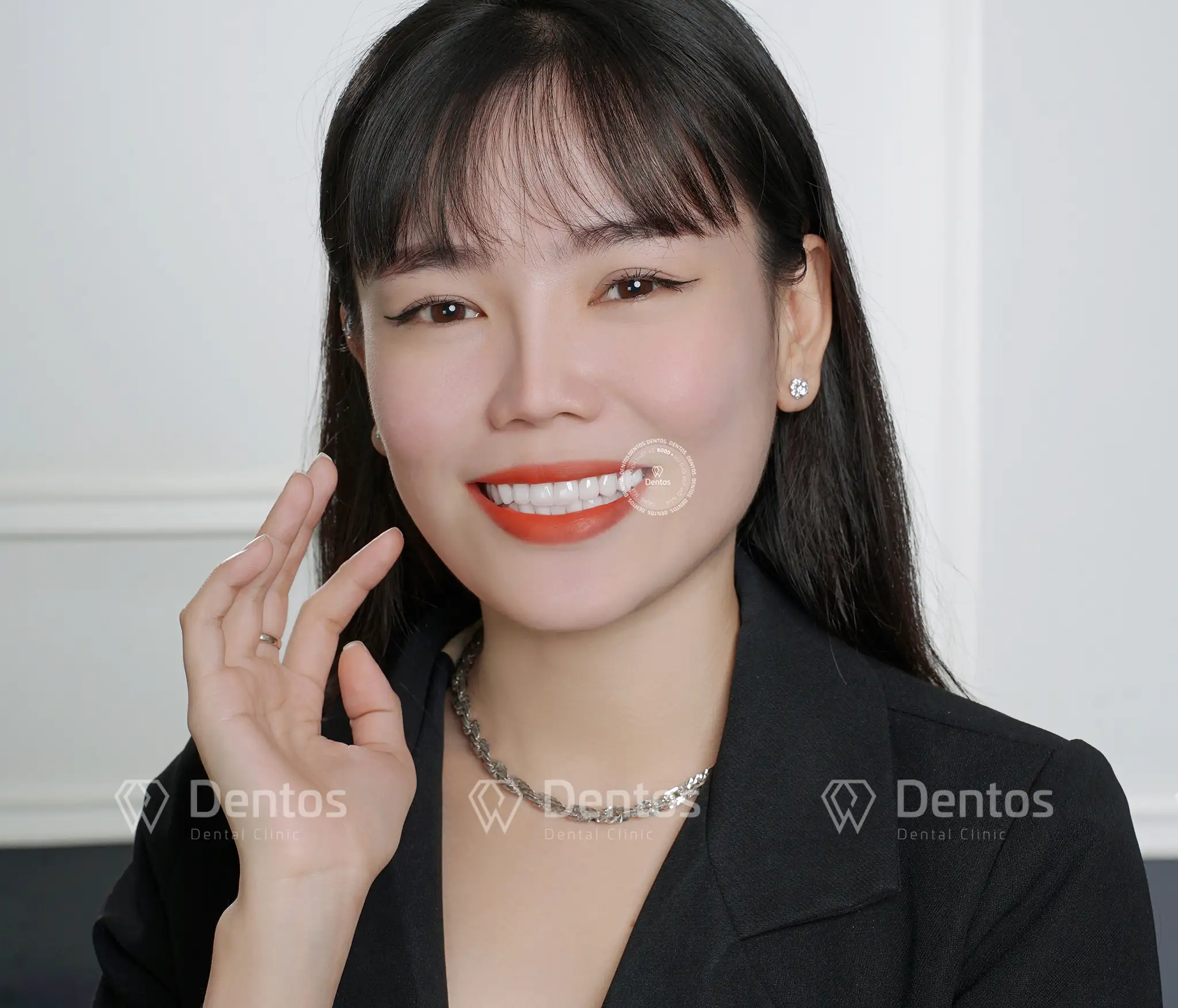 Bọc răng sứ có lấy tủy không? - Thông thường thì không